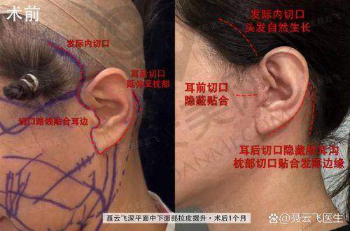 倪锋医生：小拉皮提升骨干医生