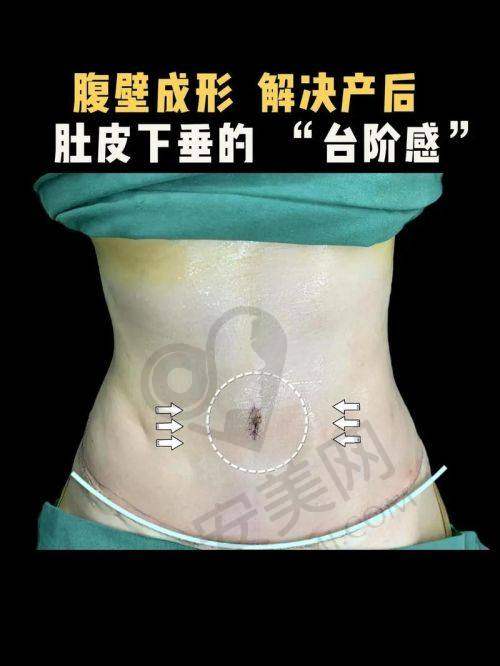 哪些人适合做腹壁成形手术？