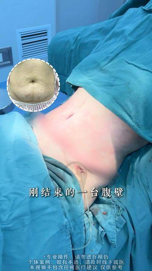 腹壁成形手术的过程是怎样的？安心有保护吗？