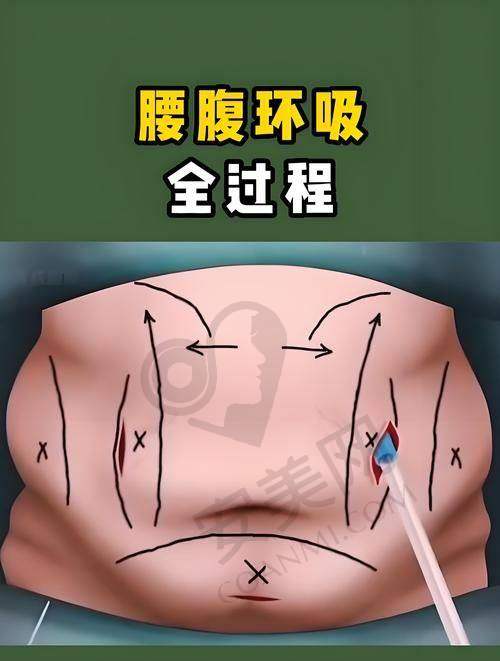 腹壁成形手术后的修复需要注意什么？