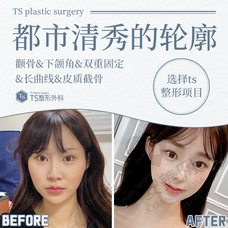 3、上海仁爱整形蹇洪医生整形技术怎么样？