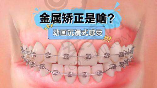 金属托槽矫正的过程是怎样的？