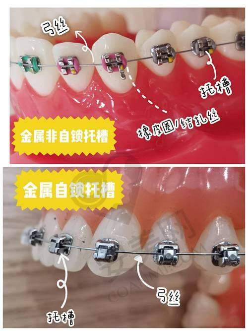 青岛维乐口腔金属托槽矫正的实例成效如何？