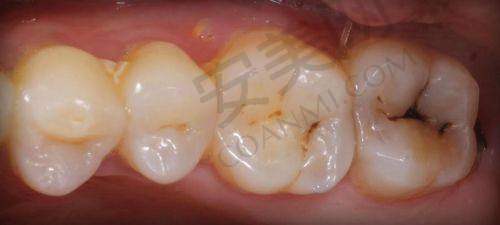 咸阳牙科补牙价格概况