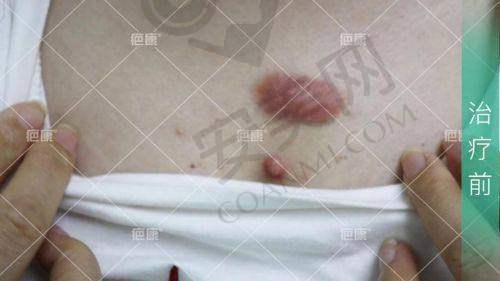 刘志超医生：疤痕疙瘩诊疗的专精具有影响力