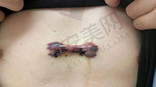 疤痕疙瘩：成因与危害