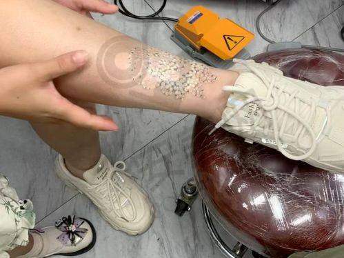 深圳悦尔疤痕医院洗纹身靠谱吗？