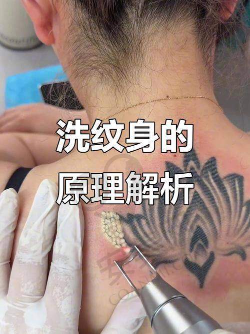 深圳悦尔疤痕医院洗纹身采用的是什么技术？