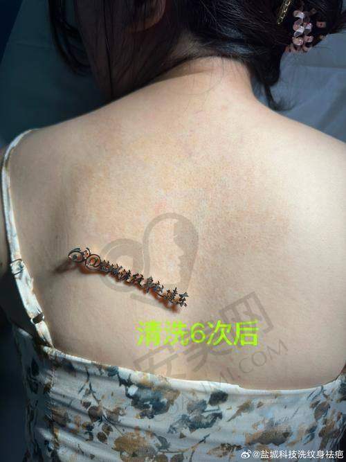深圳悦尔疤痕医院洗纹身值得推荐吗？