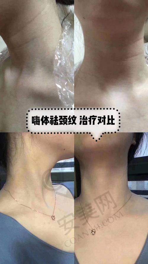 贵阳美莱饶焱院长嗨体去颈纹的成功实例多吗？