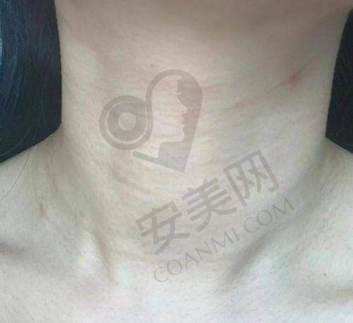 嗨体去颈纹有哪些优势？