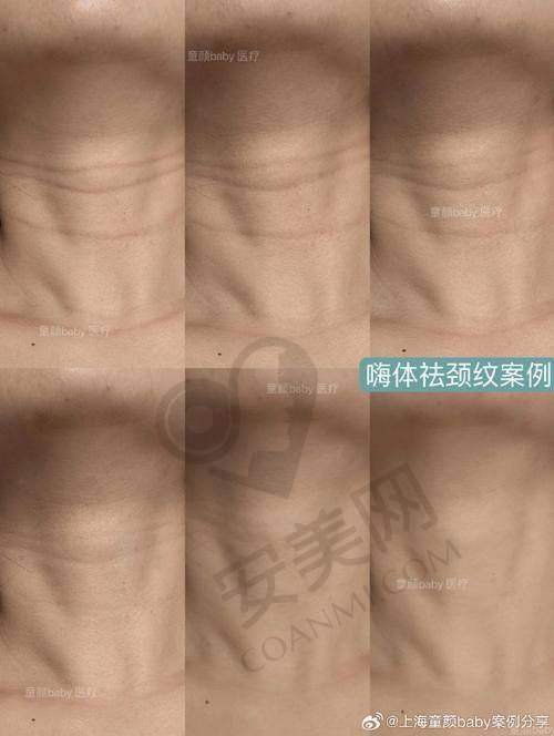 在贵阳美莱进行嗨体去颈纹治疗的流程是怎样的？