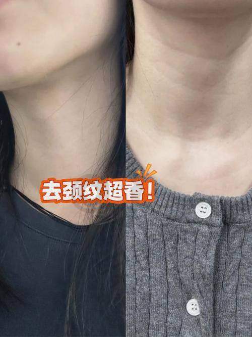 嗨体去颈纹治疗后需要注意什么？