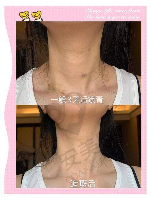 如何预约贵阳美莱饶焱院长的嗨体去颈纹治疗？