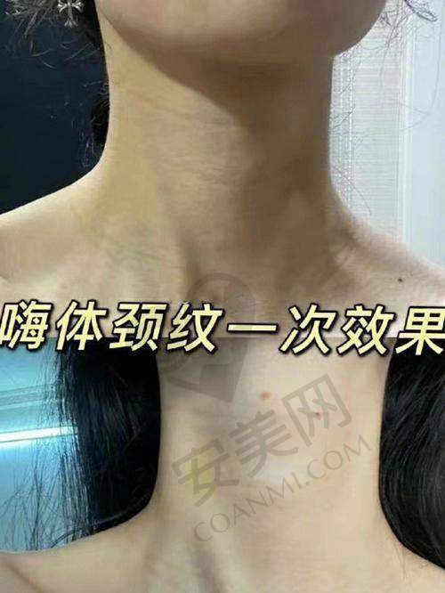 嗨体去颈纹是什么原理？