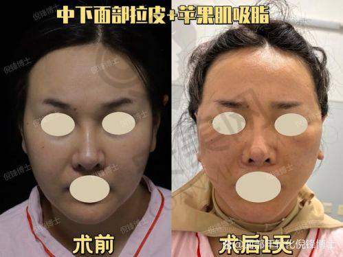 上海伯思立面部拉皮提升的服务质量如何？