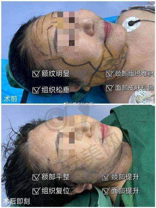 面部除皱提升项目有哪些优势？