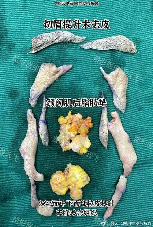 上海伯思立面部拉皮提升的价格是否合理？