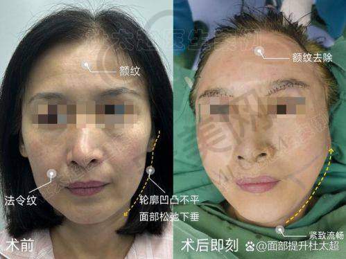 面部除皱提升手术的过程是怎样的？