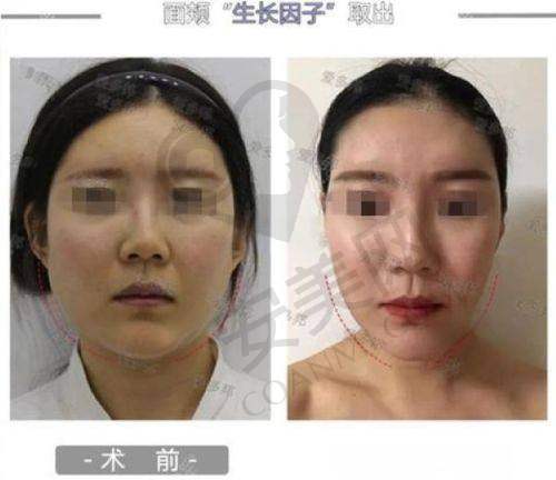 韩国ID医院全脸整容项目及价格分析