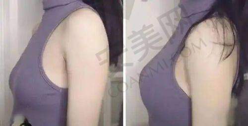 深圳艺星李高峰医生隆胸整形技术优势