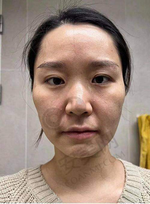 佛山医博士整形：面部吸脂的理想之选