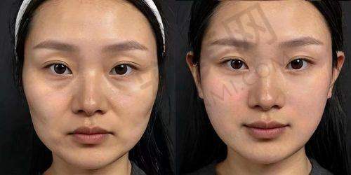 佛山曙光金子整形：轮廓整形的独特方法