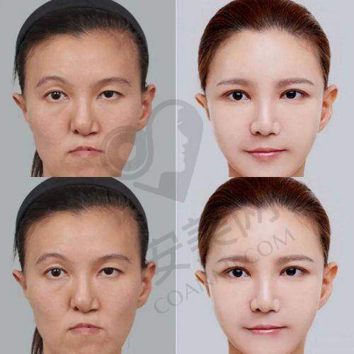 佛山佳丽整形：吸脂领域的佼佼者