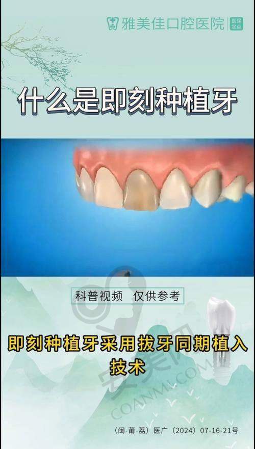 什么是即刻负重全口种植？