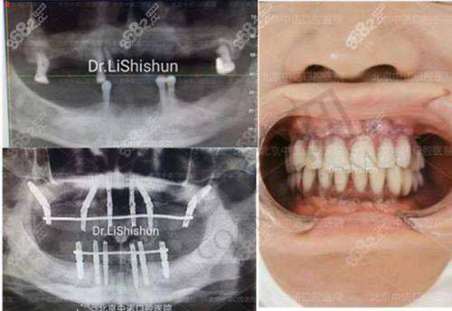 穿颧穿翼种植牙手术过程痛苦吗？