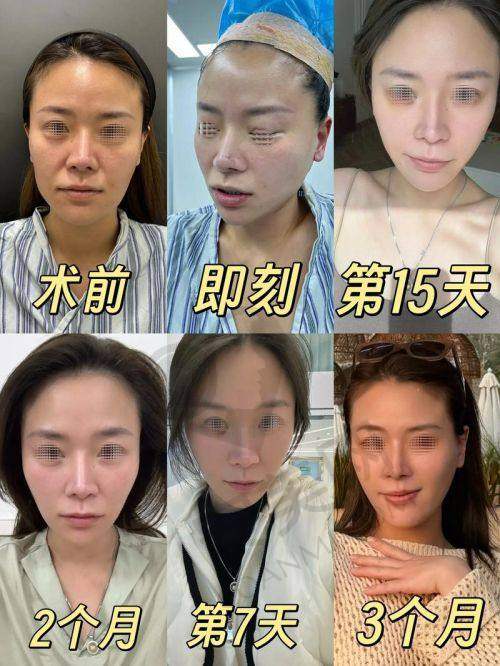 重庆星荣面部拉皮提升是什么？靠谱吗？