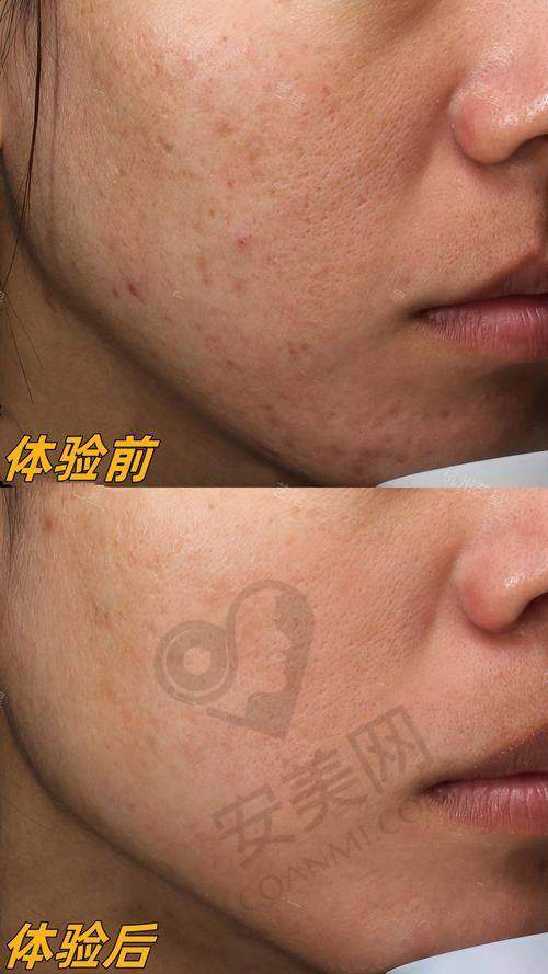 光子嫩肤的就诊过程是怎样的？疼不疼？