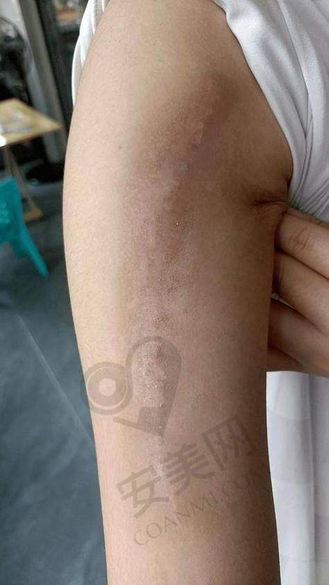 北京广济疤痕医院的后续跟踪服务是否到位？患者反馈大揭秘