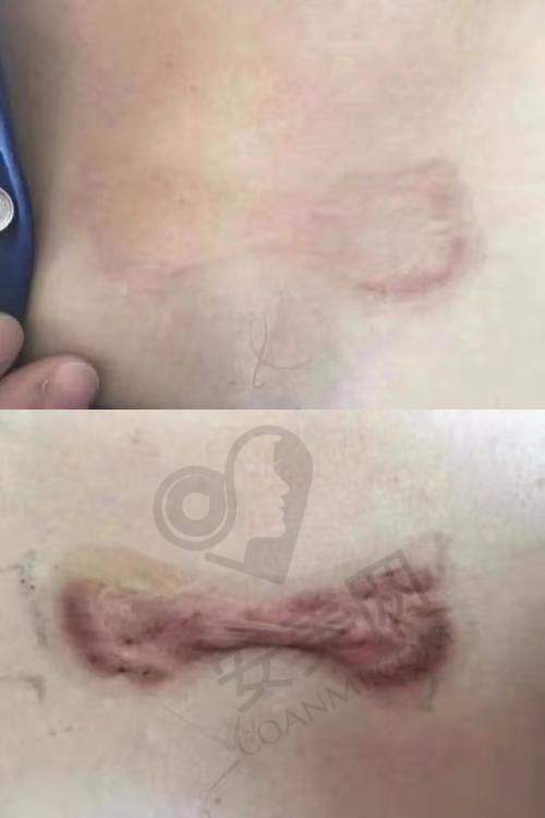 北京广济疤痕医院有人去过吗？真实探访患者现身说法