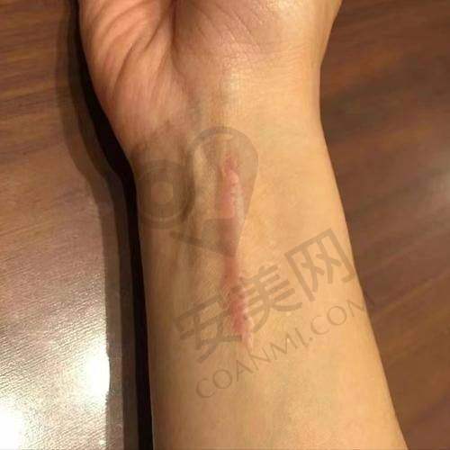 总结：北京广济疤痕医院祛外伤疤痕，值得信赖！