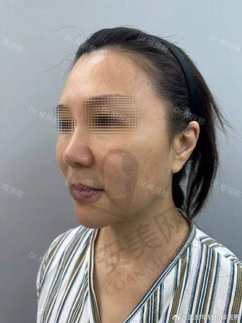 北京黄寺整形医院小切口拉皮提升的成效怎么样？