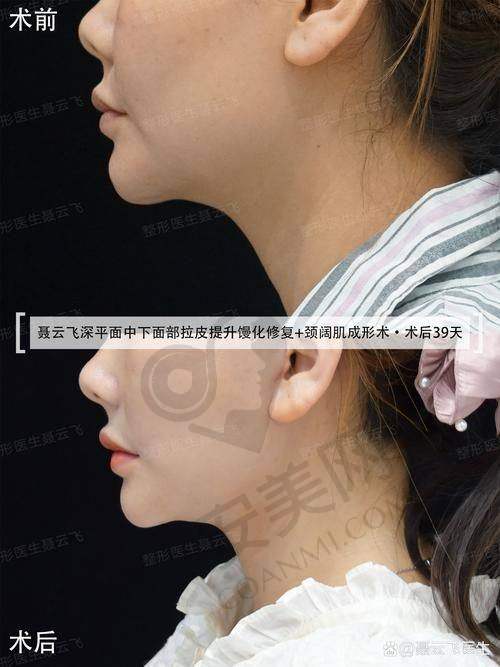北京黄寺整形医院小切口拉皮提升的特色在哪里？