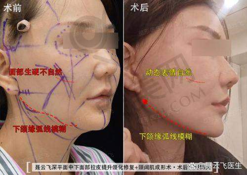 北京黄寺整形医院小切口拉皮提升是什么？