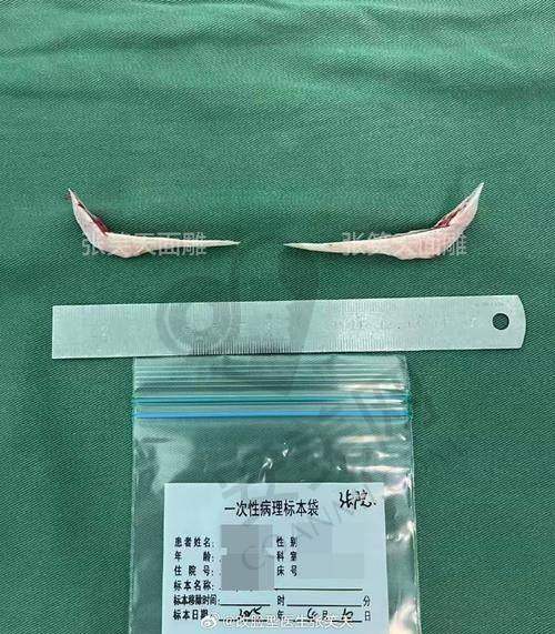 术后线条流畅自然的优势