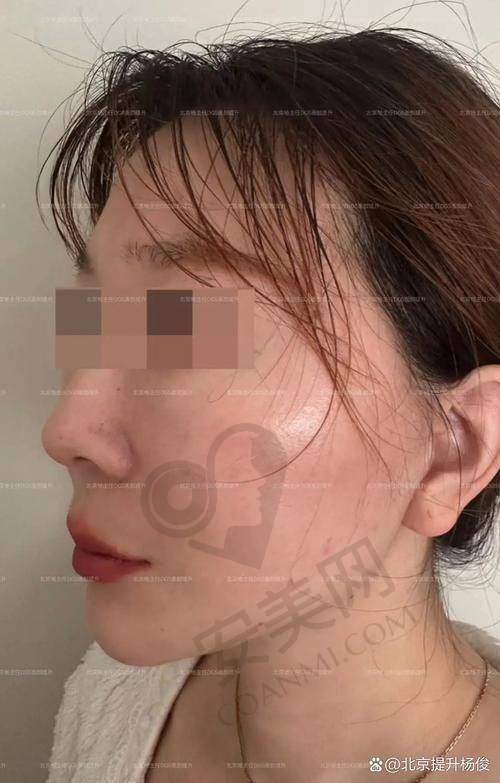 面部年轻化项目的成效能持续多久？