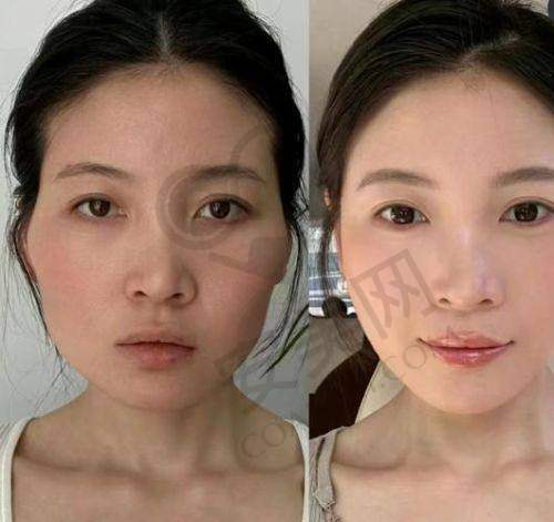 绵阳韩美玻尿酸丰眼窝技术的特色在哪里？