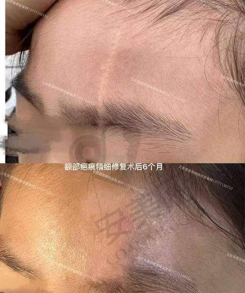 上海虹桥医院凹陷疤痕治疗成效能维持多久？