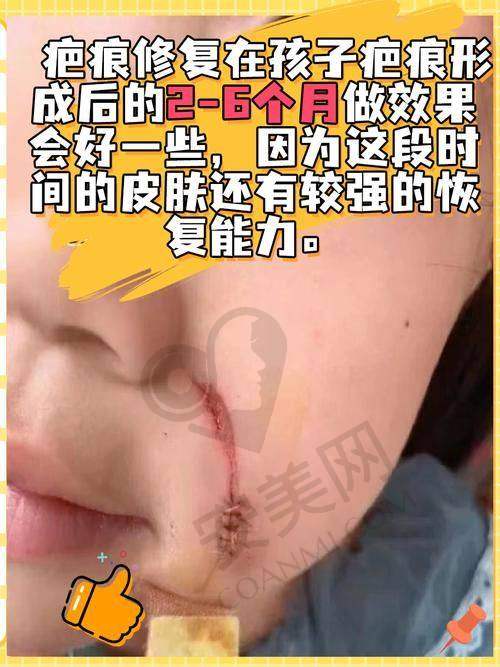 上海虹桥医院凹陷疤痕治疗采用什么技术？