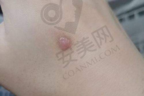 柳茂林医生：增生性疤痕修复的骨干医生