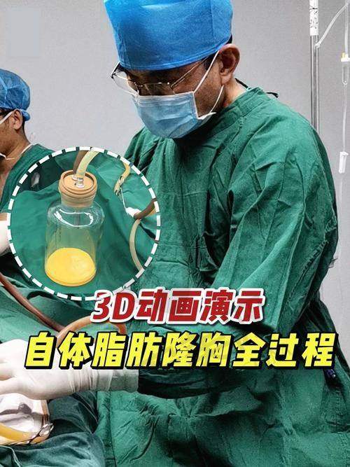 自体脂肪丰胸术后成效能维持多久？