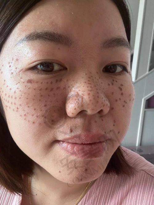 祛斑治疗过程是怎样的？