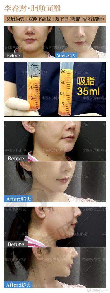 如何选择适合自己的面部吸脂方案