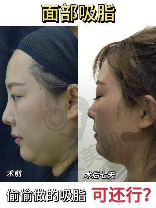 陈磊医生：面部吸脂领域的专精名咖
