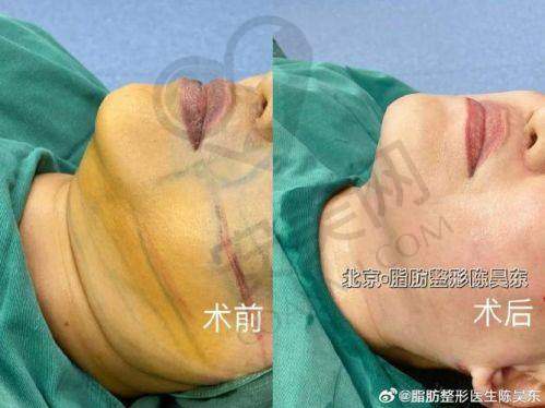 长沙梵童陈磊医生面部吸脂价格详情
