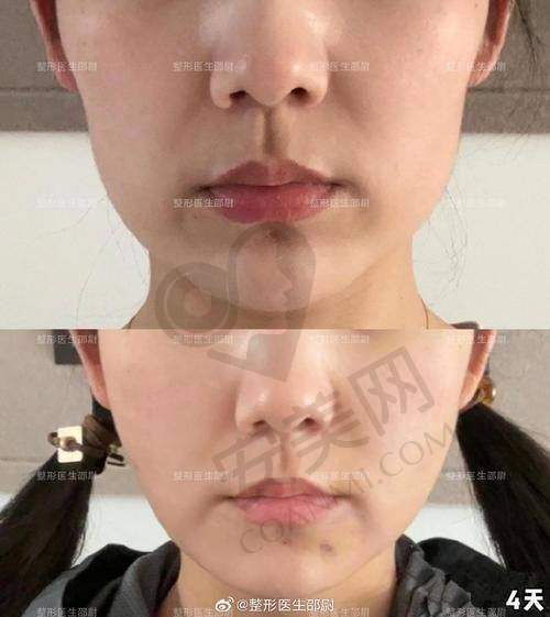 术后护理：面部吸脂成功的关键